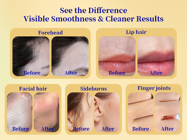 facial hair removal for women