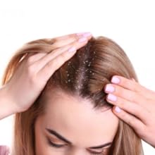 Dandruff