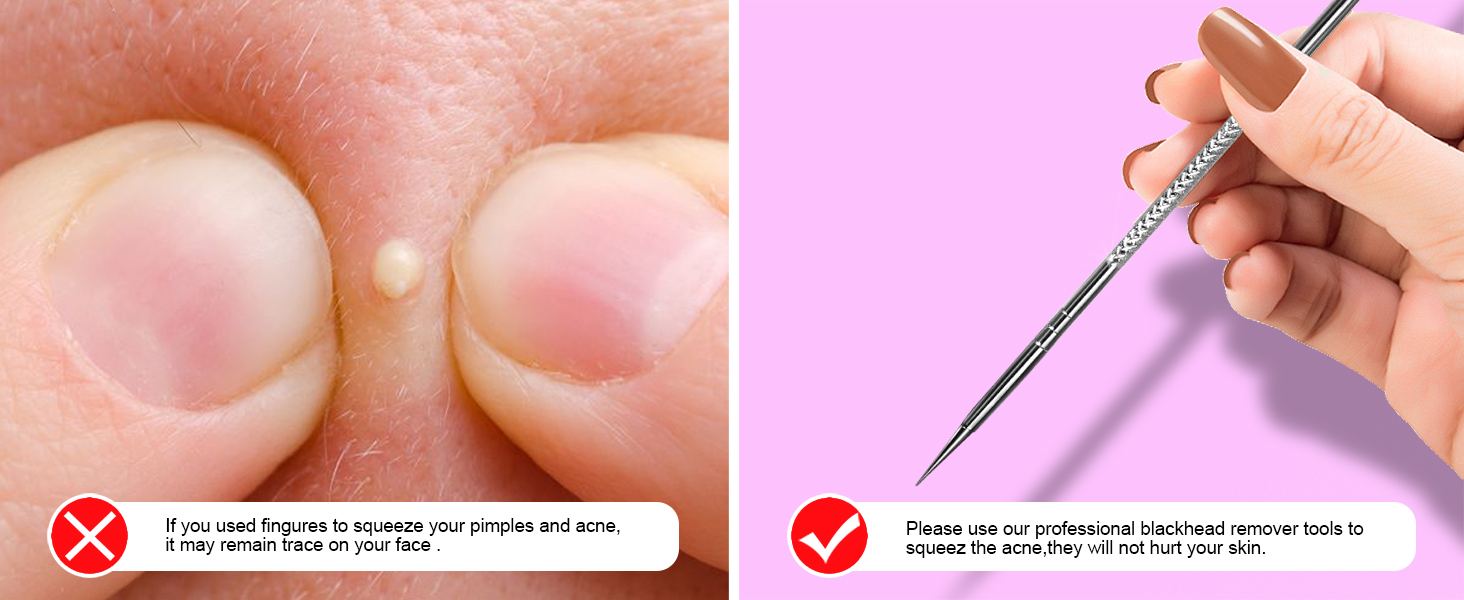 BLACKHEADS EXTRACTOR TOOLS