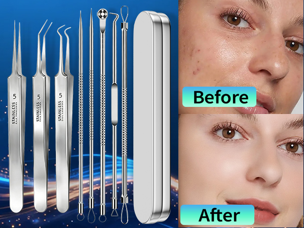 Blackhead remover