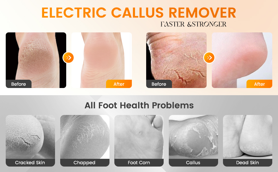 foot pain