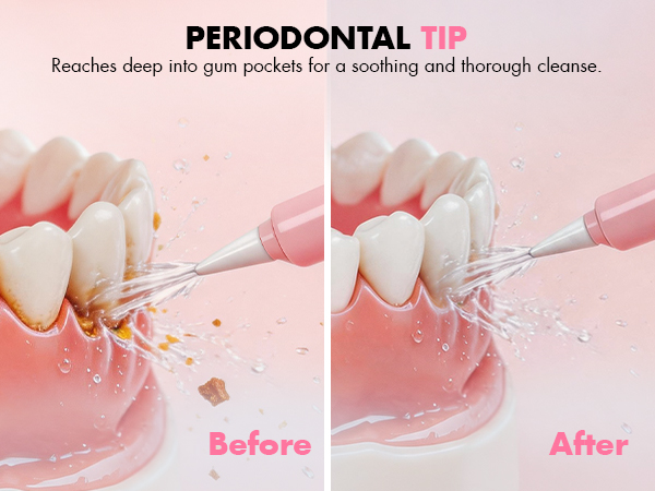 electric flosser for teeth