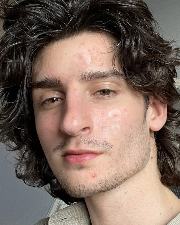pimple patches