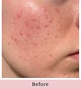 Text reads 'Before'. Close-up of facial skin showing redness, acne, and blemishes on cheek and chin area.