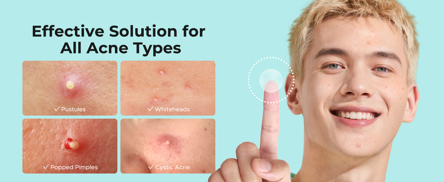 pimple patches