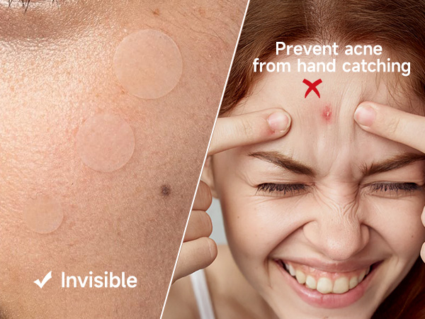 pimple patches