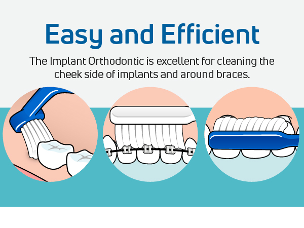 A braces toothbrush cleaning teeth.