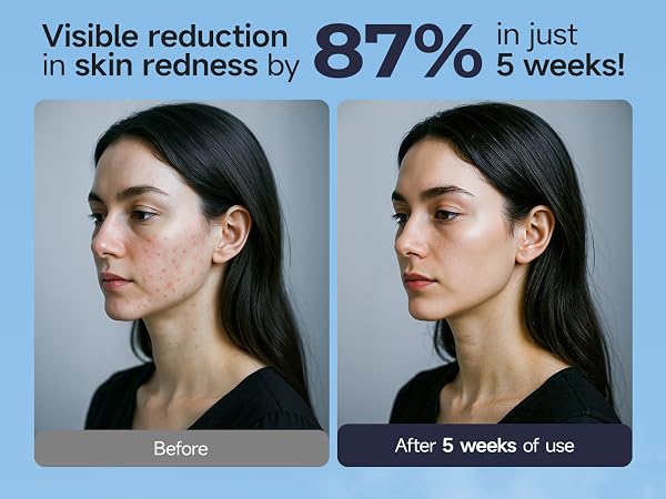 reduce redness by 87% in just 5 weeks