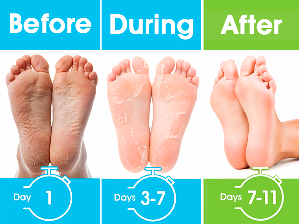 foot masks