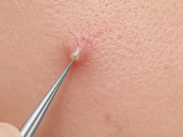 pimple popper tool