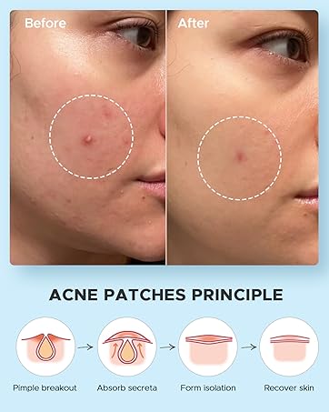 Pimple Patches