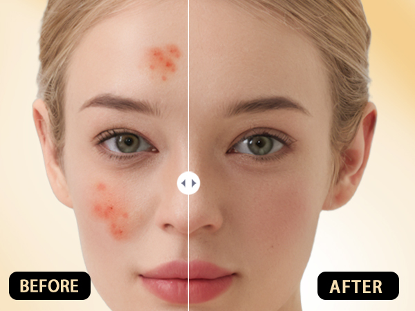 black head remover for face tool