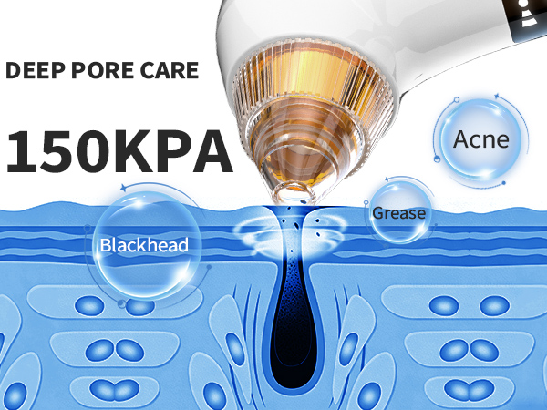 Blackhead remover