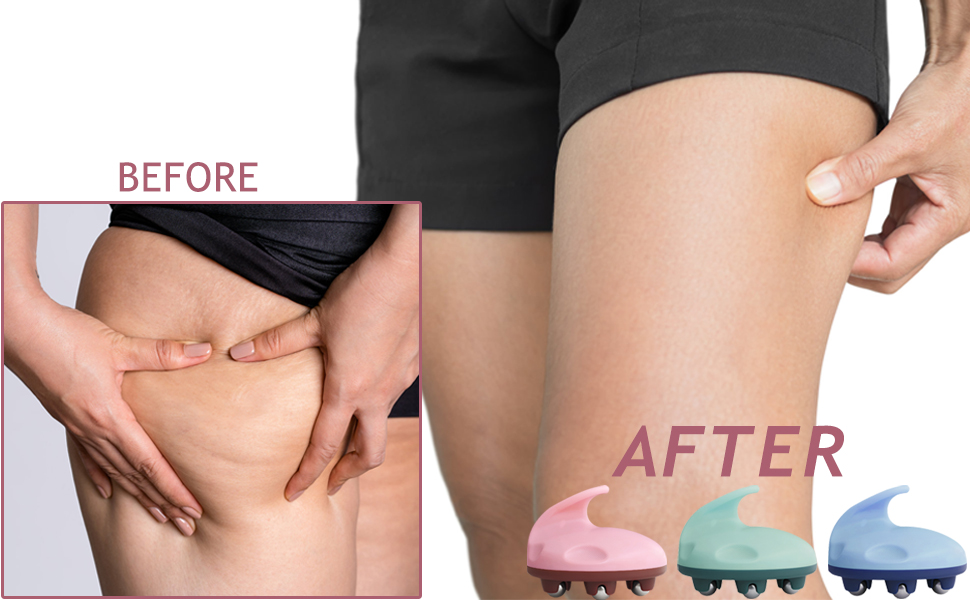 cellulite remover for legs