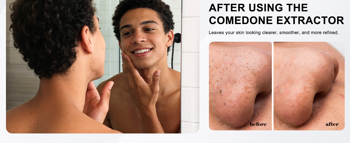 black head remover comedone extractor blackhead extraction kit pimple tool pimple remover acne