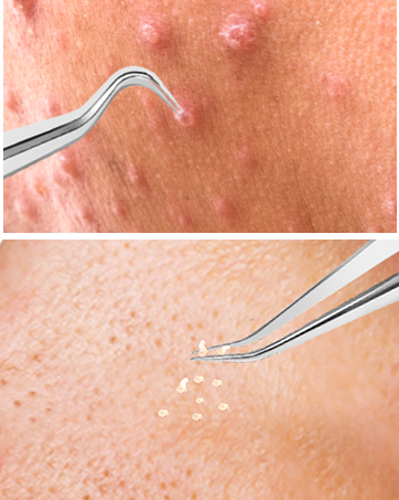 Ingrown Hair Tweezers