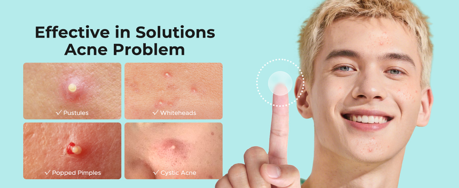 pimple patches for face