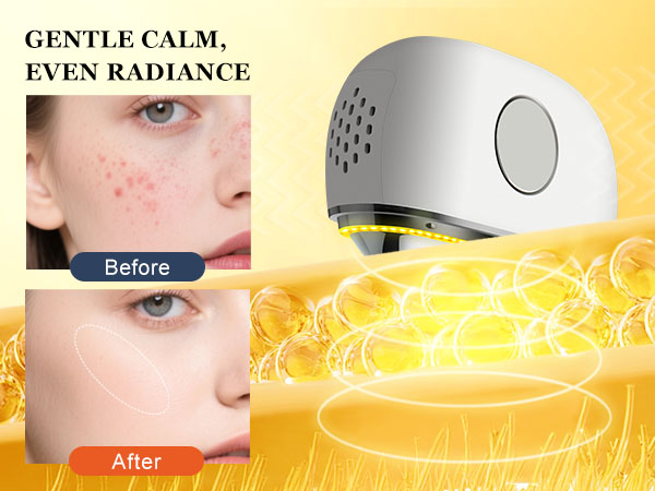 Yellow Light – Gently Calm Surface Redness