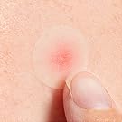 acne patches for face