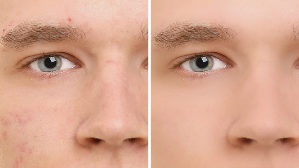 A comparison between a blemished and a smooth skined man face.