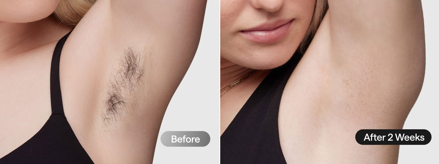 Ulike PCUL5 Swift 5 Ice Cooling IPL Hair Removal Device