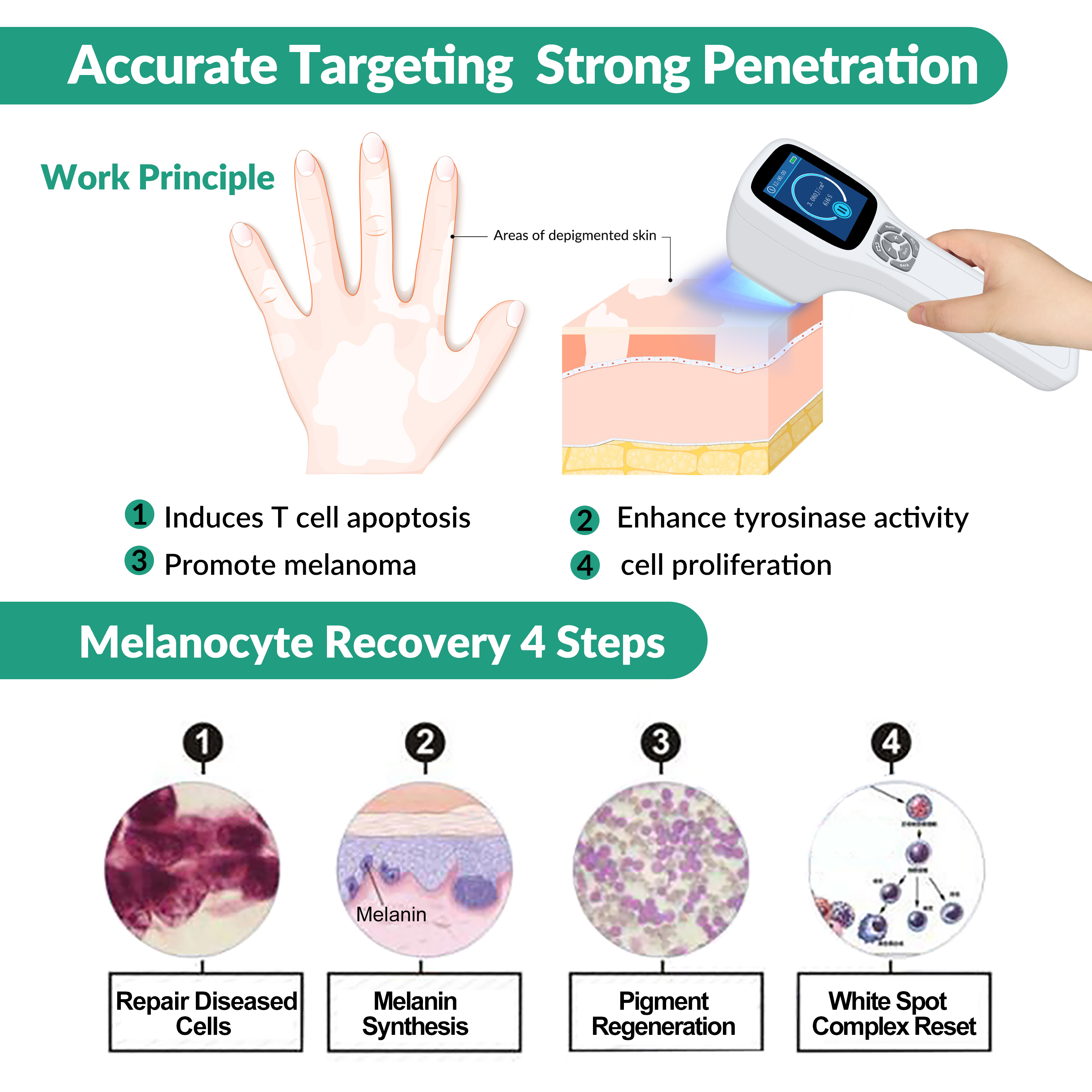 308nm UVB Phototherapy Working Principle