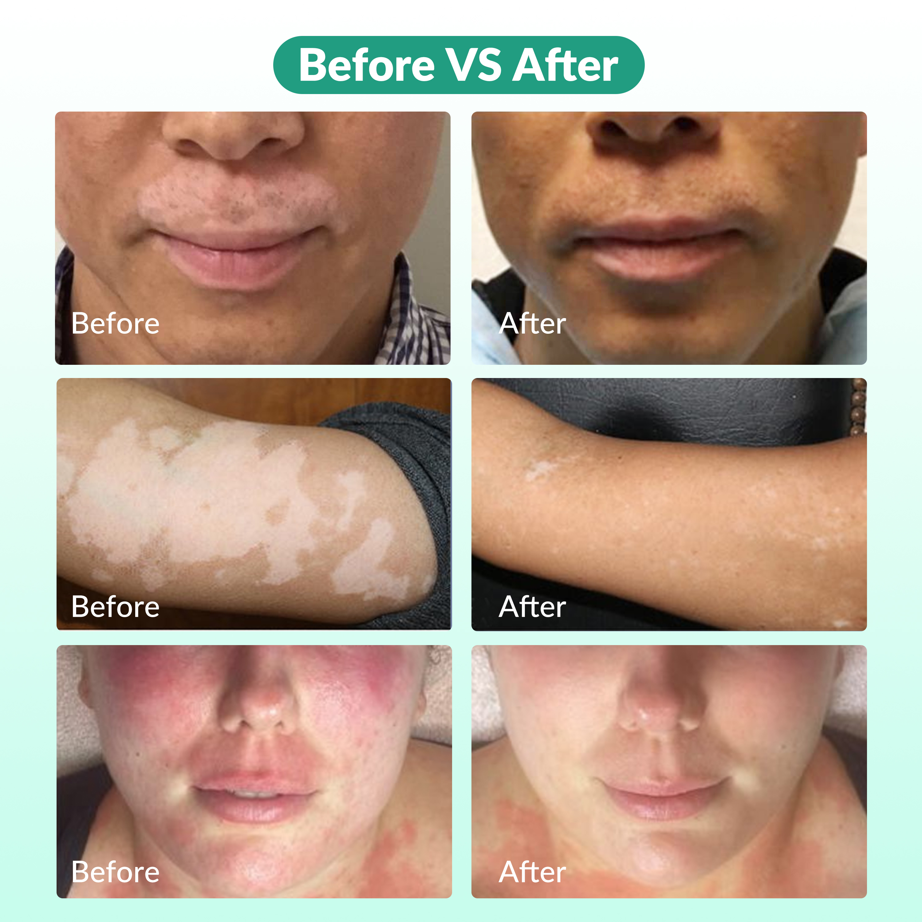 308nm UVB Phototherapy Skin Results Comparison