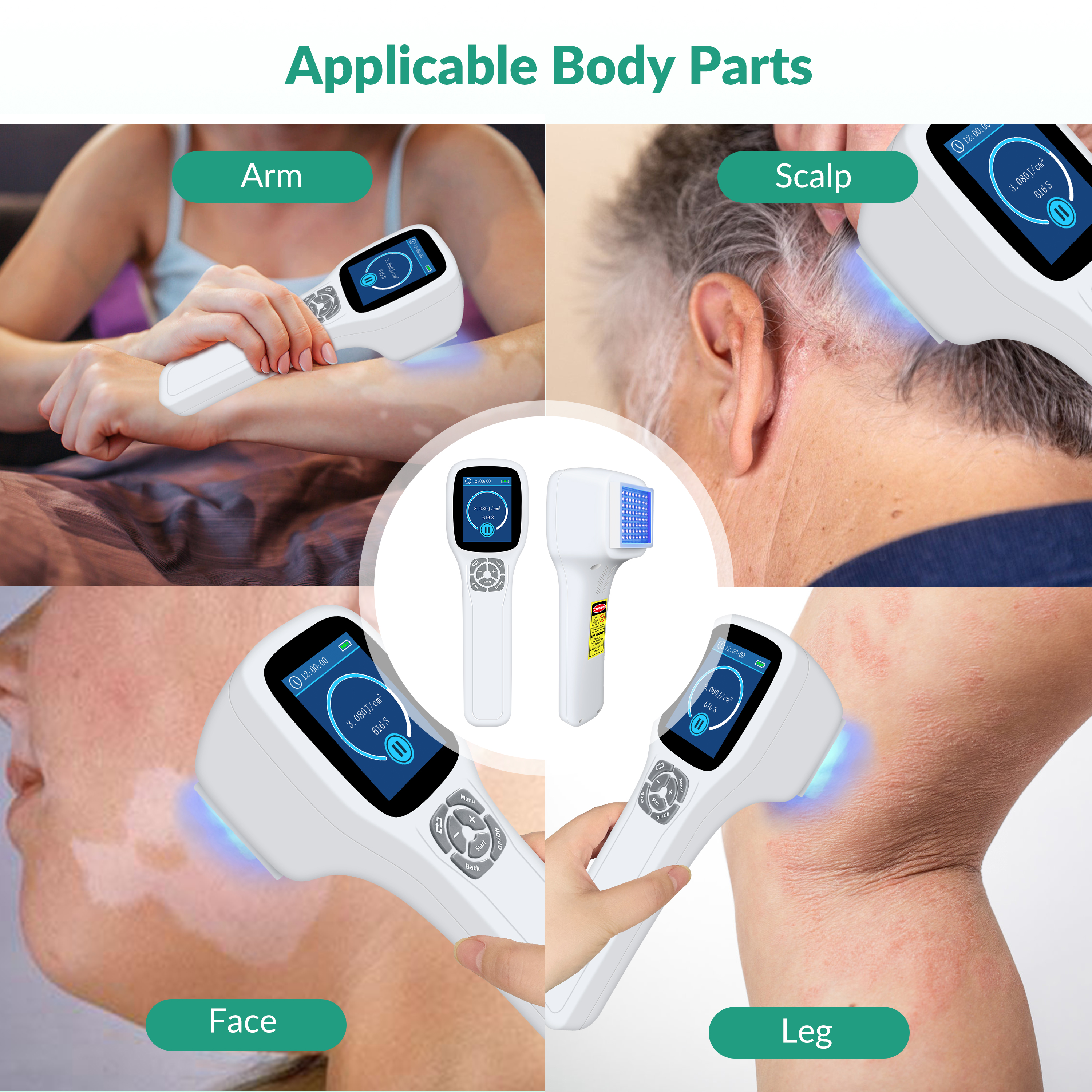 308nm UVB Light Therapy Application Areas