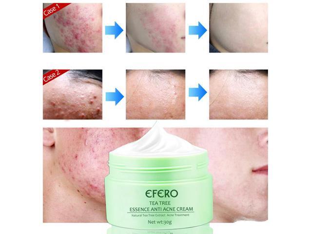 green tea anti acne essence cream
