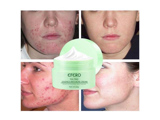 green tea anti acne essence cream