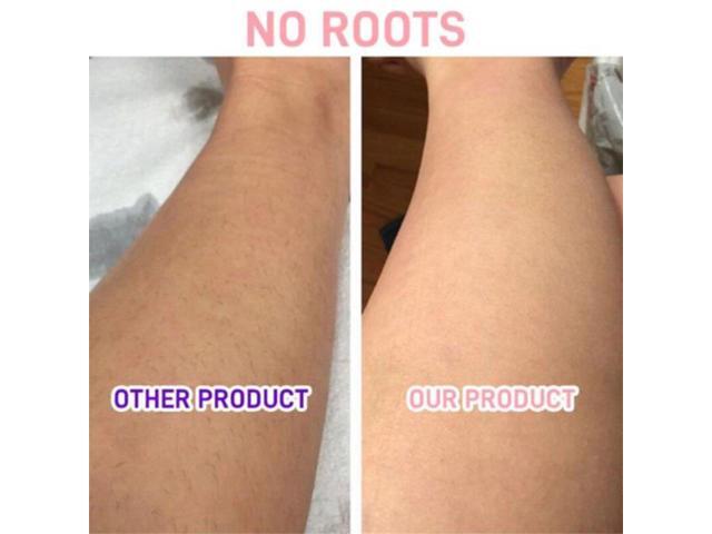 эффект от лазерной эпиляции. можно заниматься спортом после лазерной эпиляции. депиляция скинс глубокое бикини. после лазерной эпиляции. эпиляция зоны бикини александритовым лазером.