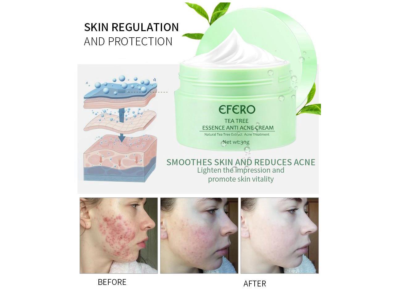 green tea anti acne essence cream