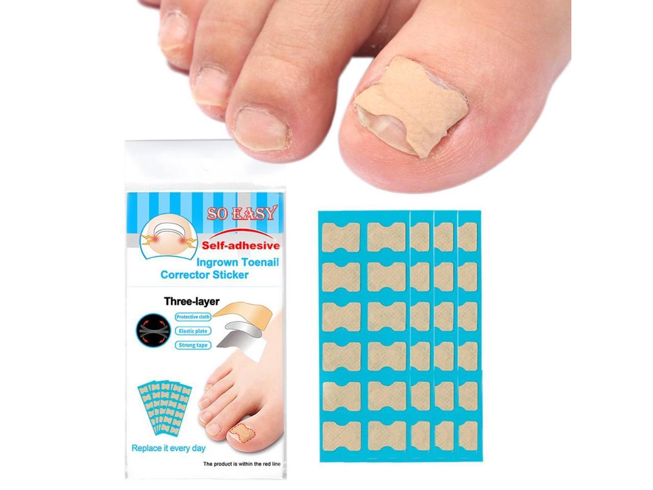 1 Set Ingrown Toenail Corrector Stickers Toe Nail Treatment Patch 60