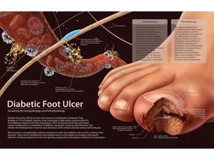 Histopathology and pathophysiology of diabetic food ulcers Poster Print by Enid HajderiStocktrek Images (17 x 11) Histopathology and pathophysiology of diabetic food ulcers Poster Print by Enid HajderiStocktrek Images (17 x 11)