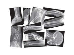 Roylco R-5914 Broken Bone Compound Fracture X-Rays