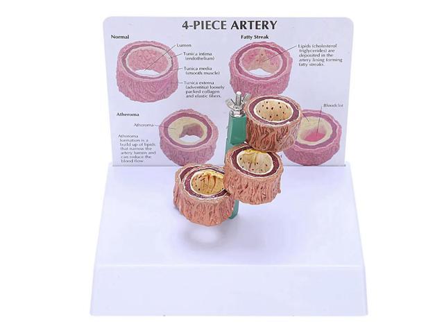 3X Atherosclerosis Thrombosis Model Vascular Disease Demonstration Heart Vascular Pathology Model