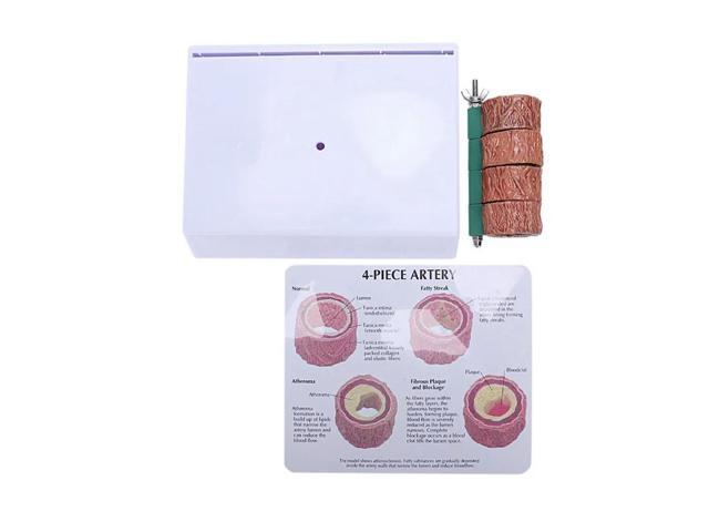 3X Atherosclerosis Thrombosis Model Vascular Disease Demonstration Heart Vascular Pathology Model