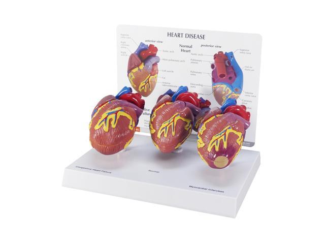 3-Piece Mini Heart Model Set, Normal and Diseased Human Body and Anatomy Replica for Physiology Education, Anatomical Model for Doctor's Office,...