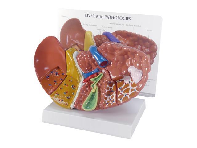 Liver Model with Common Pathologies Human Body and Anatomy Replica for Physiology Education, Anatomical Model for Doctor's Office, Medical...