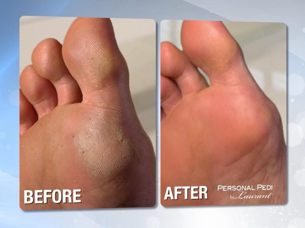 Alt view image 6 of 8 - Personal Pedi Foot Callus Remover