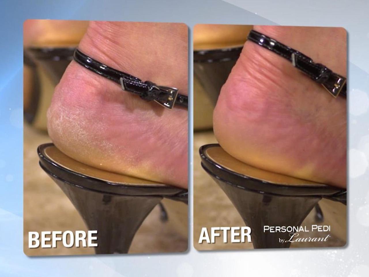 Alt view image 7 of 8 - Personal Pedi Foot Callus Remover