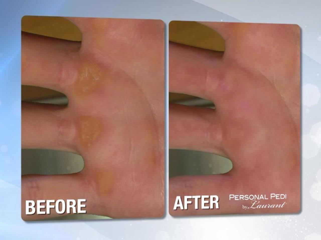 Alt view image 8 of 8 - Personal Pedi Foot Callus Remover