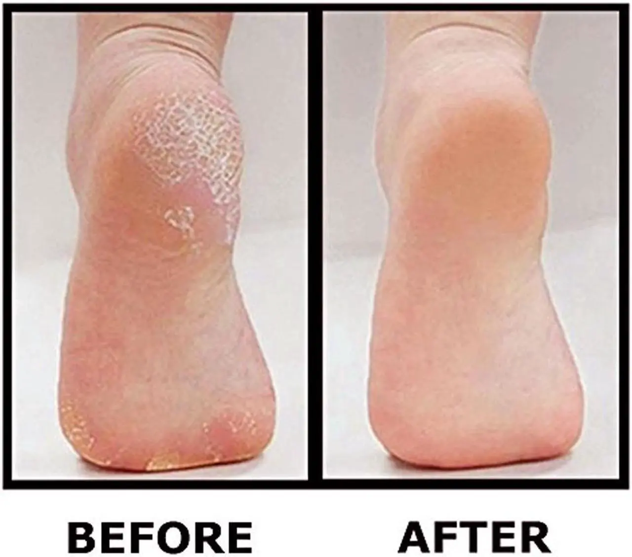 Alt view image 6 of 6 - Best Pedicure Foot File - Ultimate Callus Remover for Spa-Like Results