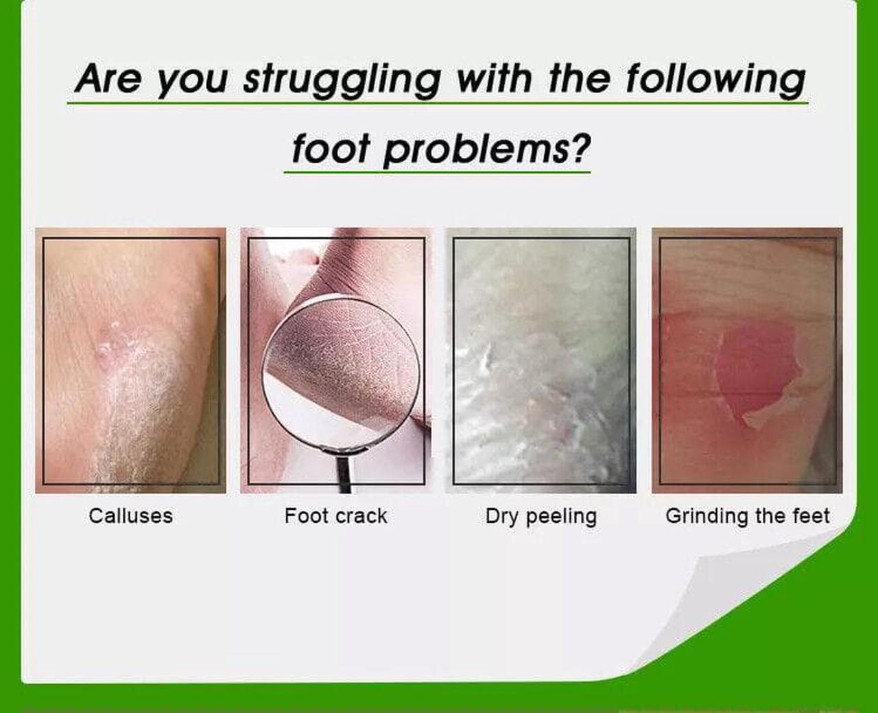 Alt view image 5 of 6 - UREA 40 Cream Antifungal Foot Cream, Salicylic Acid For Jock Itch Ringworm 4f.oz
