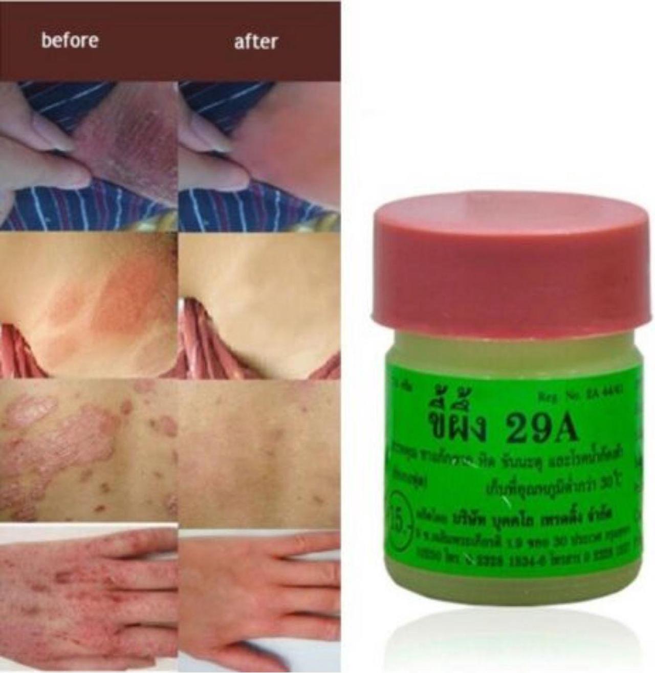 Alt view image 3 of 4 - Scabies Treatment - ScabiDerm Herbal & Natural Cream - Salicylic Acid & Sulfur Kill Scabies Mites - 29A Ointment Antimicrobial and Anti-fungal Lotion Plus Antiseptic - Fast Acting Relief (2 x 7.5g)