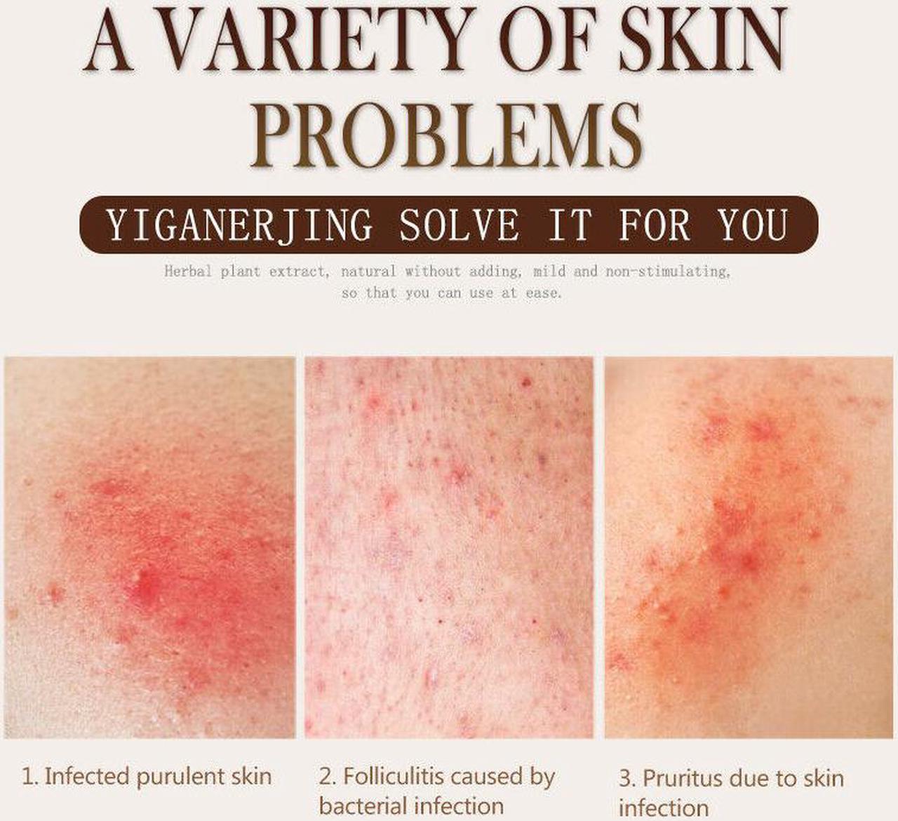 Alt view image 6 of 6 - 10 tubes YIGANERJING Skin Psoriasis Cream Dermatitis Eczematoid Eczema Ointment
without box