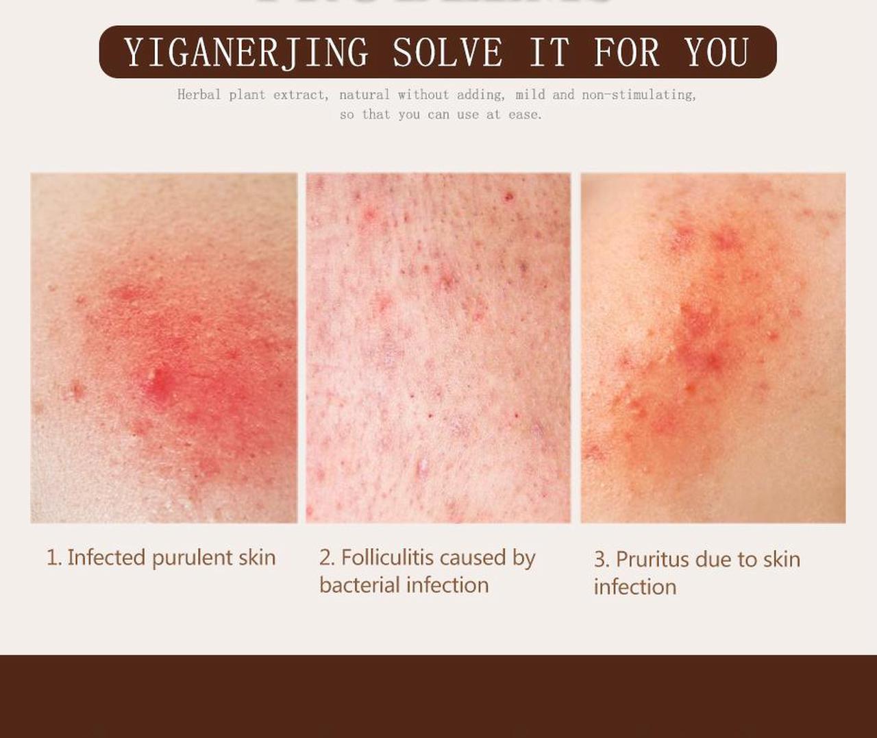 Alt view image 5 of 7 - 10 Tubes YIGANERJING Chinese Herbal Cream Skin Psoriasis Cream Dermatitis Eczematoid Eczema Ointment With Mini Soap