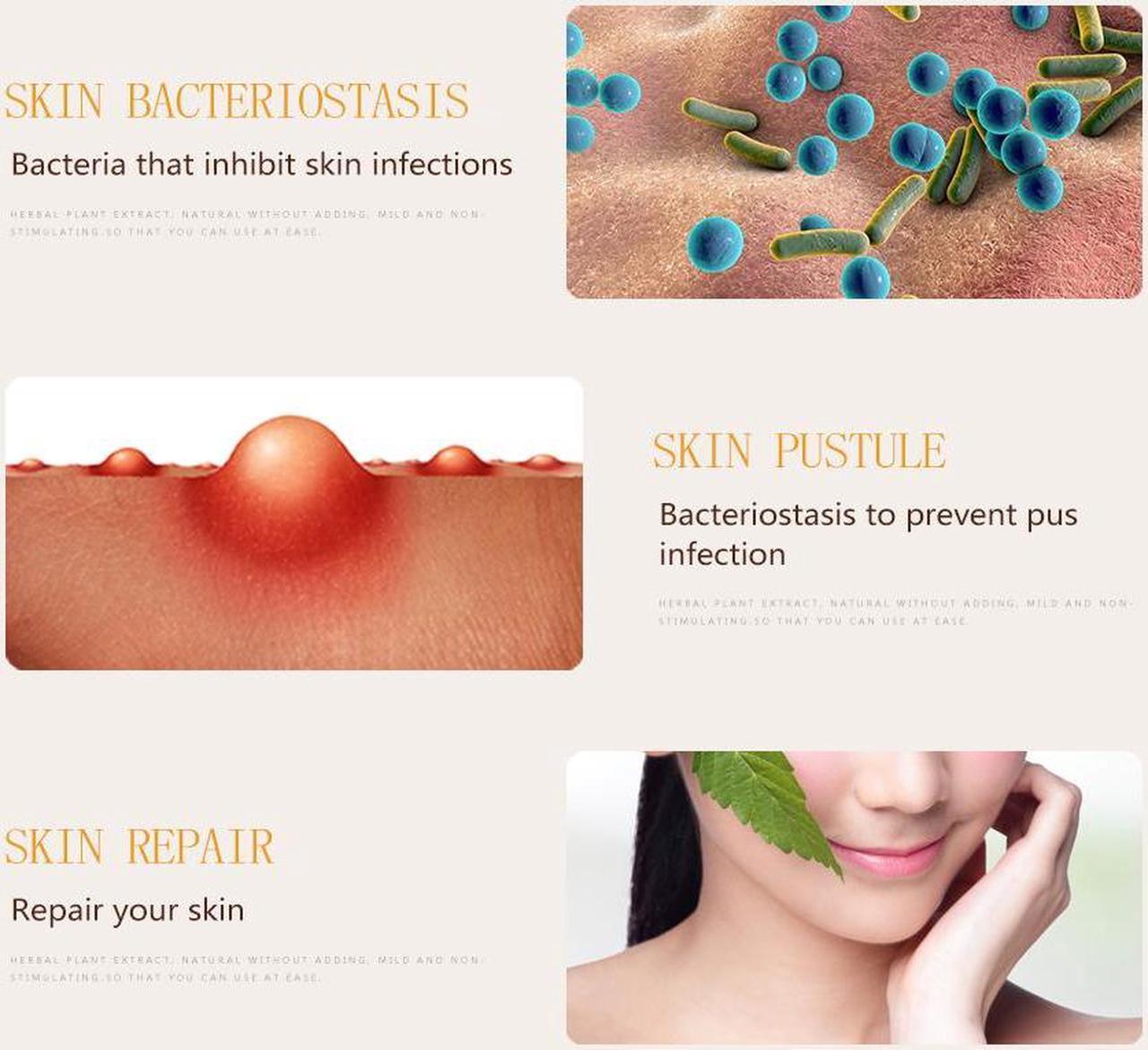 Alt view image 6 of 7 - 10 Tubes YIGANERJING Chinese Herbal Cream Skin Psoriasis Cream Dermatitis Eczematoid Eczema Ointment With Mini Soap