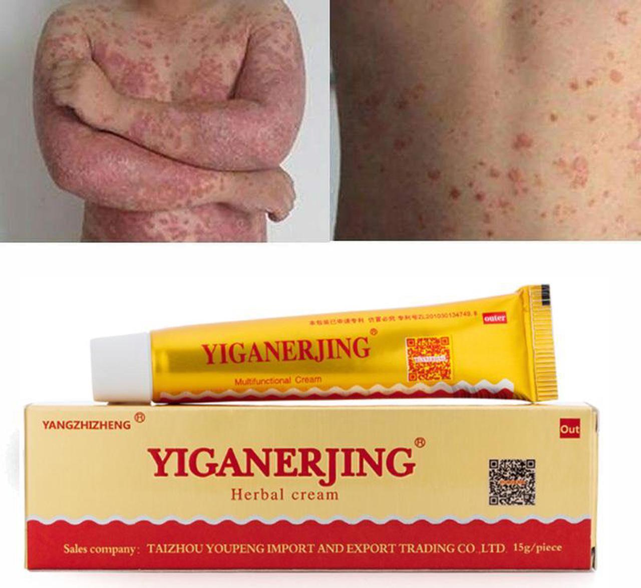 Alt view image 4 of 7 - 10 Tubes YIGANERJING Chinese Herbal Cream Skin Psoriasis Cream Dermatitis Eczematoid Eczema Ointment With Mini Soap