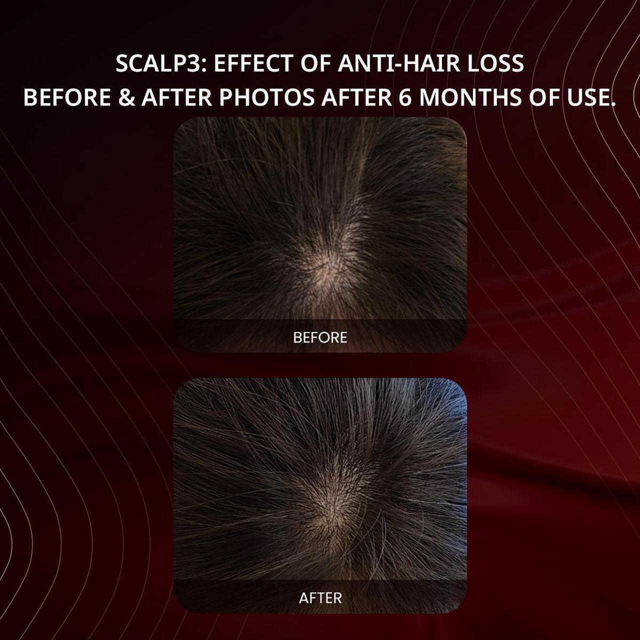 Alt view image 4 of 7 - Breo Scalp3 Scalp Massager Comb Anti Hair Loss Scalp Massaging brush Hair Growth Care Scalp Hair Therapy Scalp Reduction Redlight Infrared Therapy Head Massager Grey